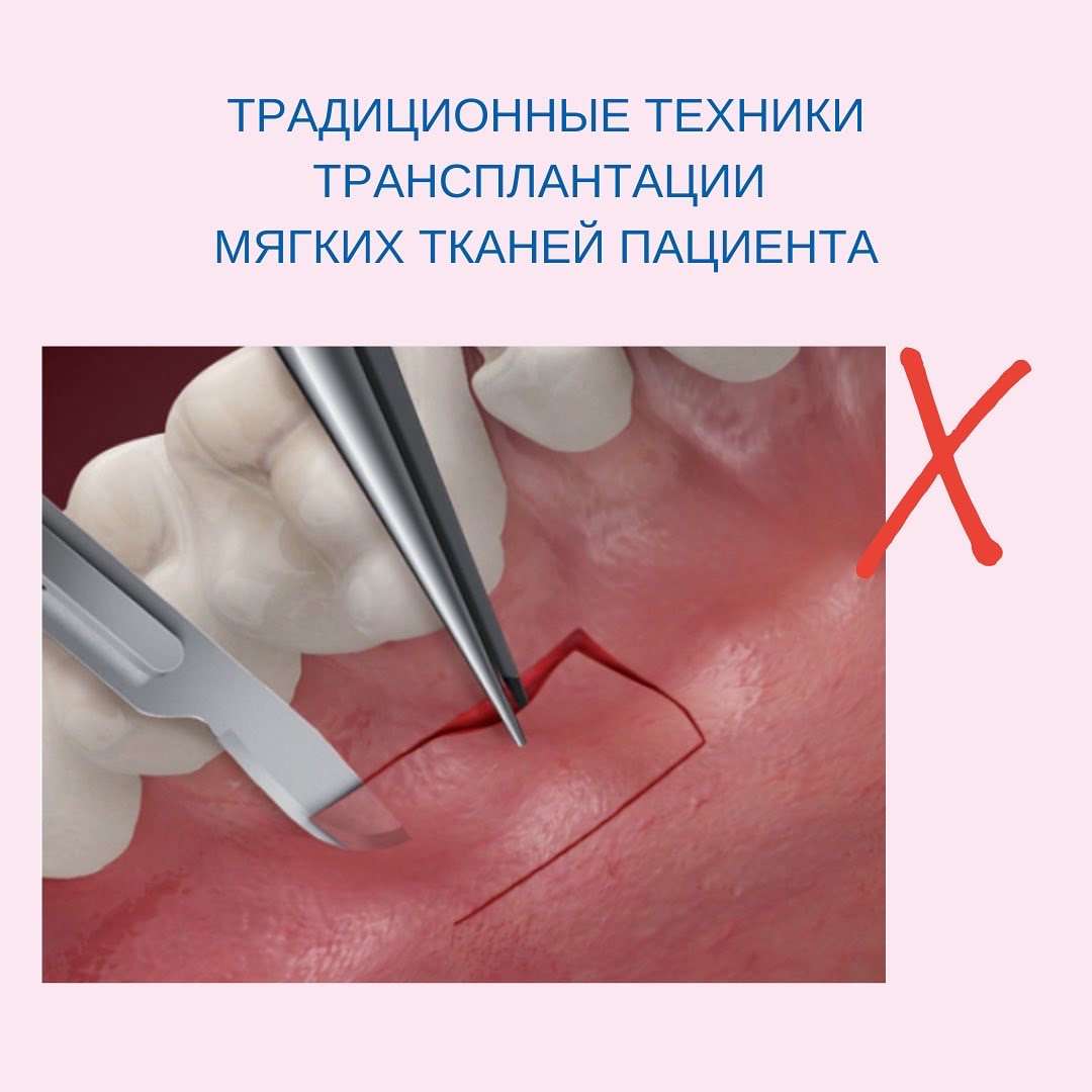 Плюсы и минусы решений для восстановления десневых тканей