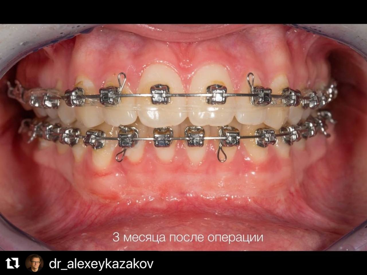 Вестибулопластика с применением Geistlich Mucograft
