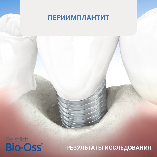 Периимплантит и мукозит: проблема и способы решения