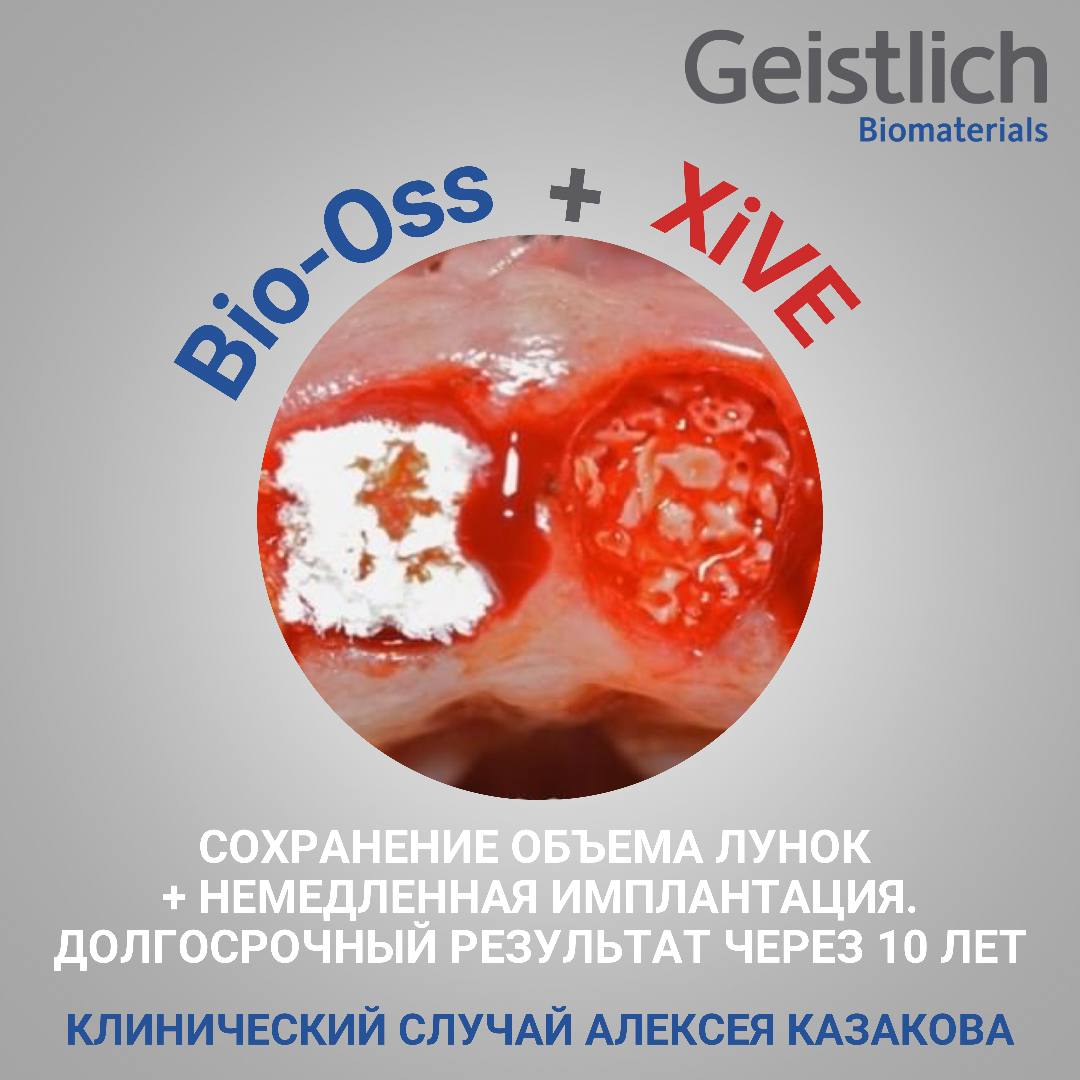 Клинический случай Алексея Казакова с материалами Geistlich