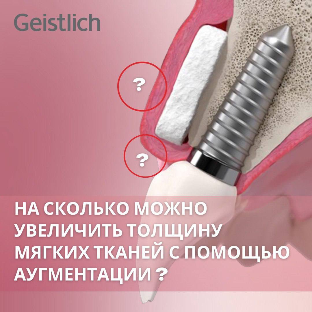Утолщение мягких тканей при аугментации с применением матрикса Geistlich Fibro-Gide