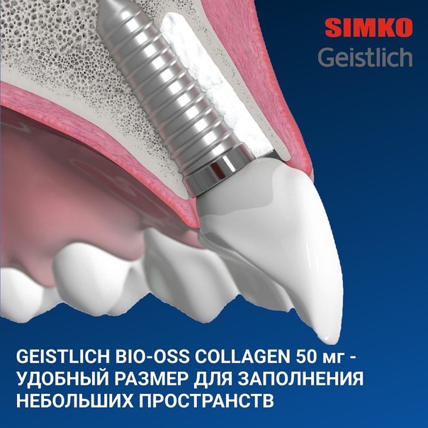 50-миллиграммовый блок Geistlich Bio-Oss Collagen: удобно для маленьких промежутков