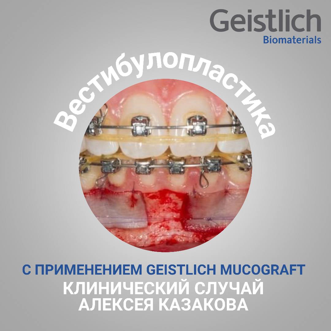 Вестибулопластика с применением Geistlich Mucograft