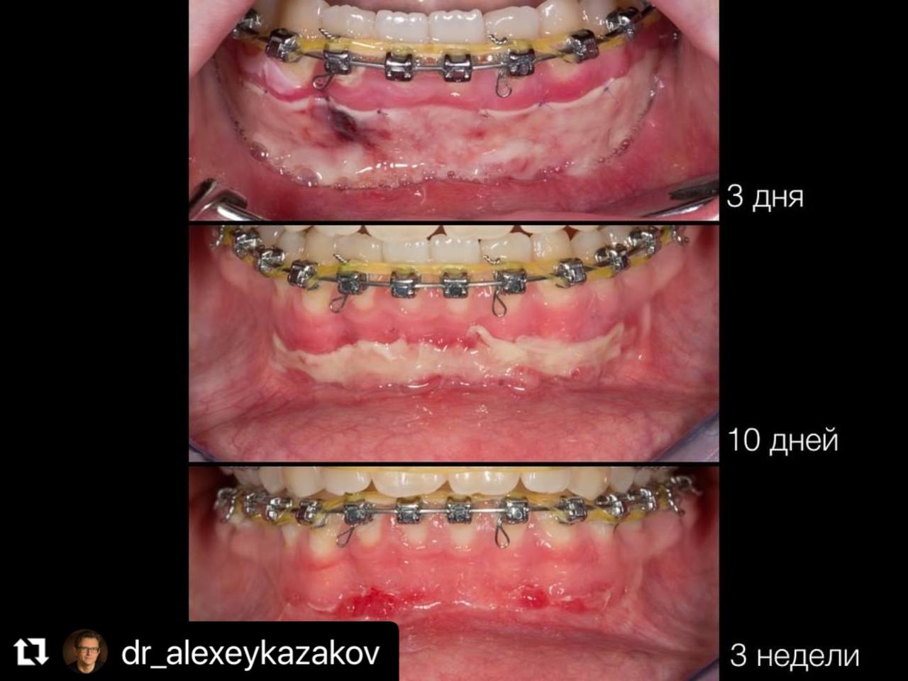 Вестибулопластика с применением Geistlich Mucograft