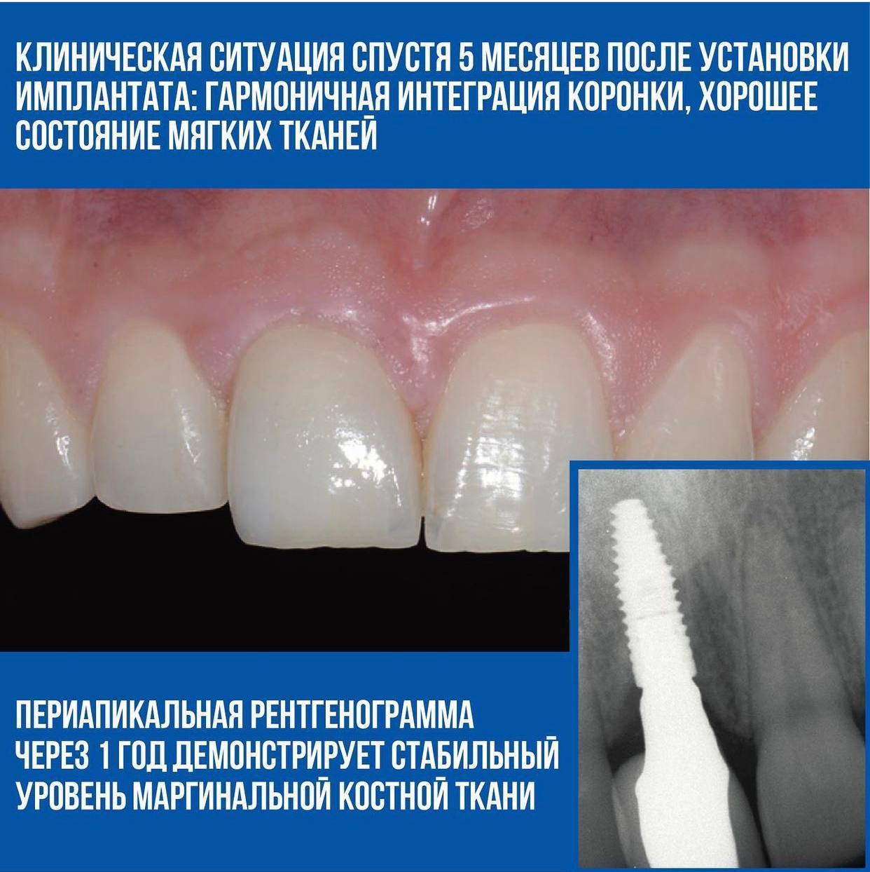 Техника L-shape. Клинический случай Рональда Юнга
