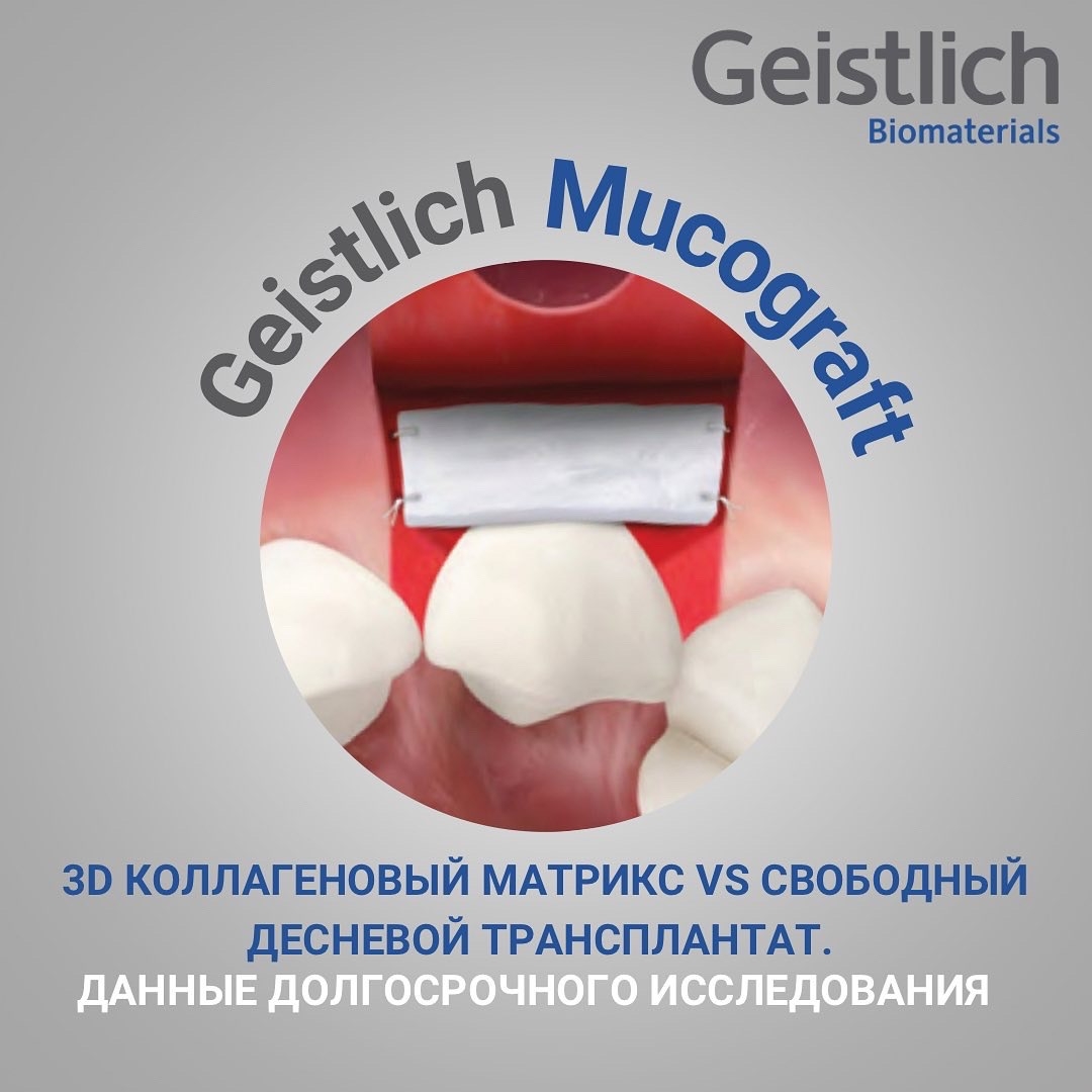 3D коллагеновый матрикс vs свободный десневой трансплантат. Данные долгосрочного исследования.