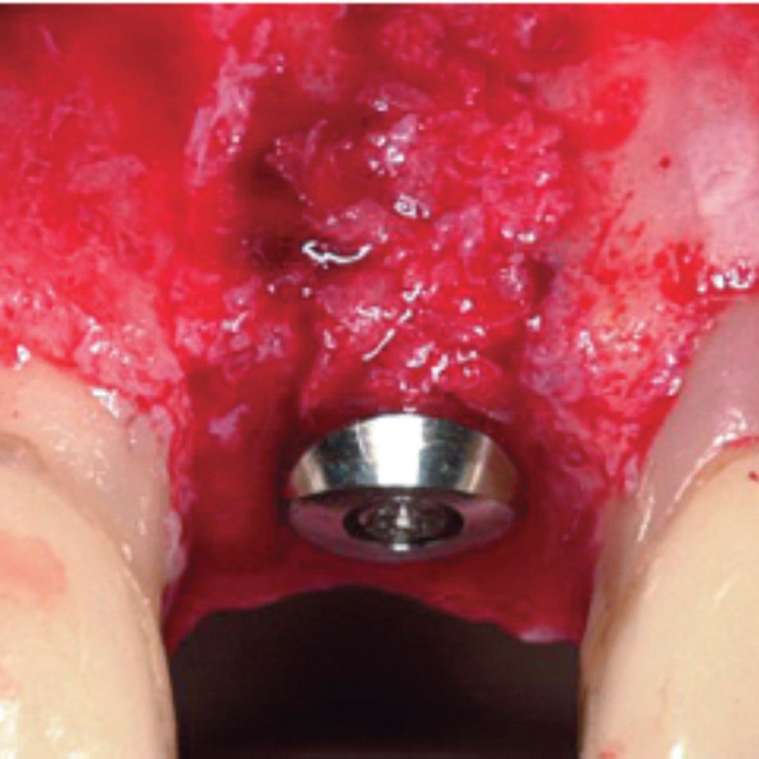 Предсказуемость отдаленных результатов применения биоматериалов Geistlich в лечении десен подтверждена исследованиями
